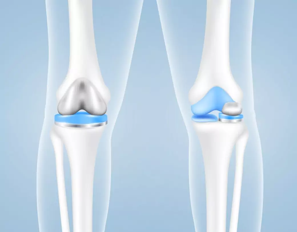 What Are The Alternatives to Knee Replacement Surgery?


