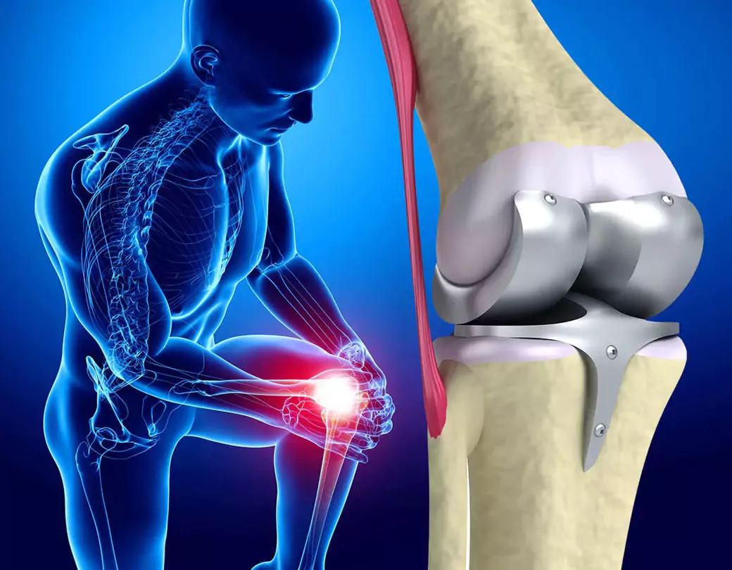 What Are the Risks and Benefits of Knee Surgery for Arthritis?