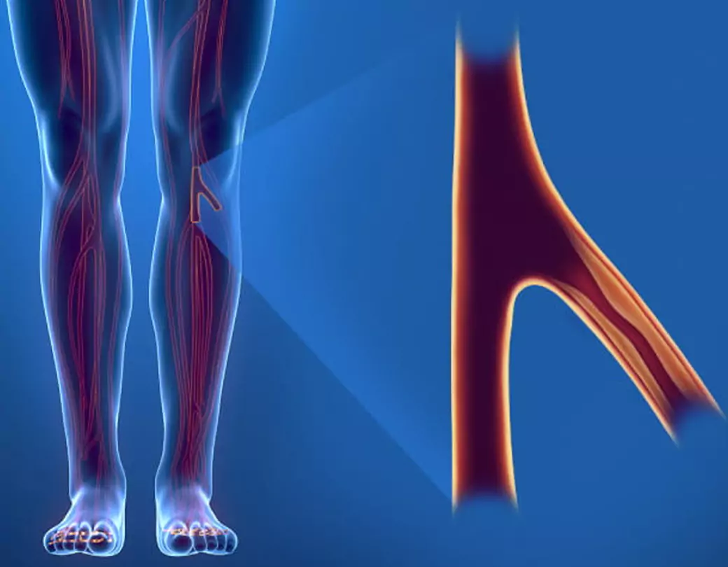 Can Exercise Improve Blood Flow in Lower Limb Ischemia?
