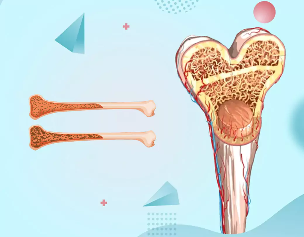 What is the Purpose of a Bone Marrow Transplant?
